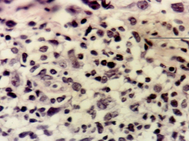 Fig.3: ATLL biopsia Cutnea H-E - <div style=